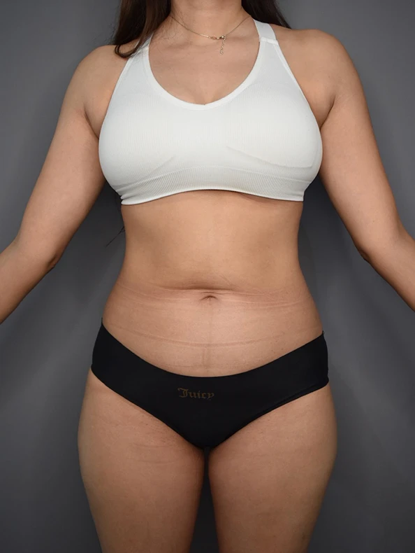 Antes Lipoabdominoplastía
