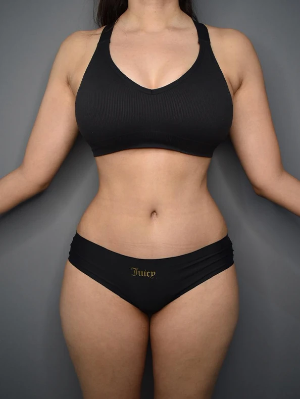 Después Lipoabdominoplastía