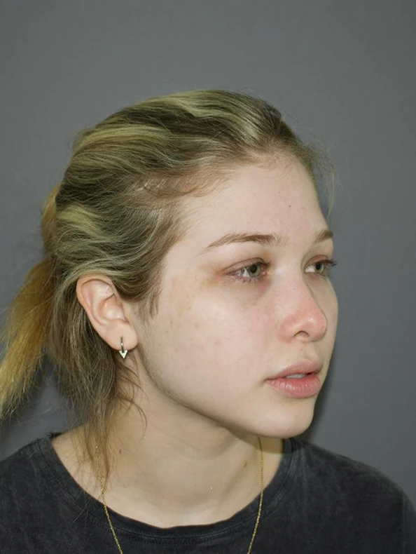 Antes Lipopapada (Lipo de Cuello)